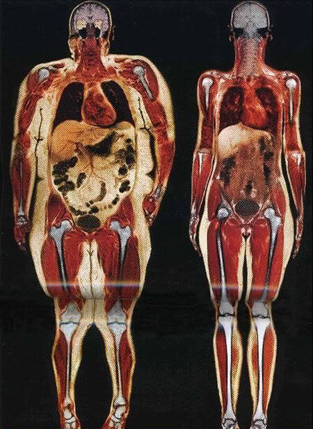 sweatsalty:

This is stunning. Look at the pressure on the ankles, how the organs are constricted, how the joints are held at awkward angles, and how large the internal organs are.
This is just as good thinspo as attractive, skinny girls in bikinis.